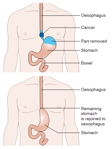 Oesophageal & Gastric Cancer Surgery